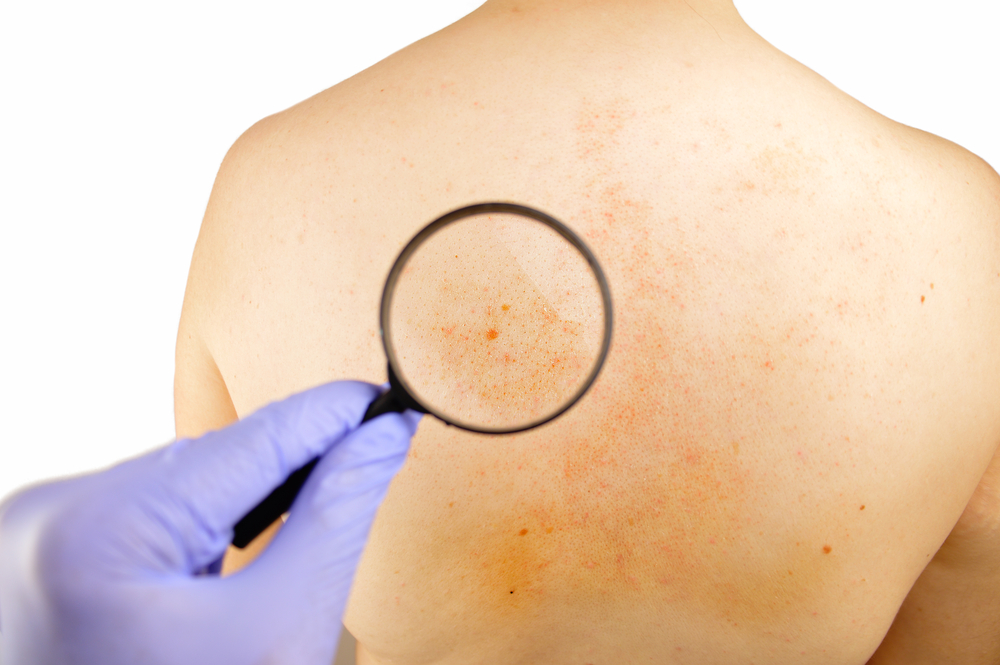 Problemas de pele: Conheça os tipos de dermatite