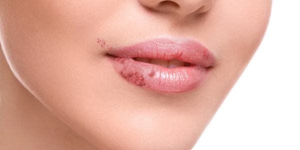 Herpes: saiba como se pega e como se proteger