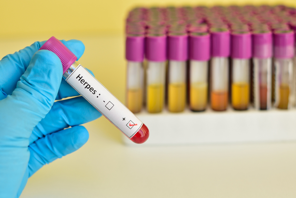 Herpes: saiba como se pega e como se proteger